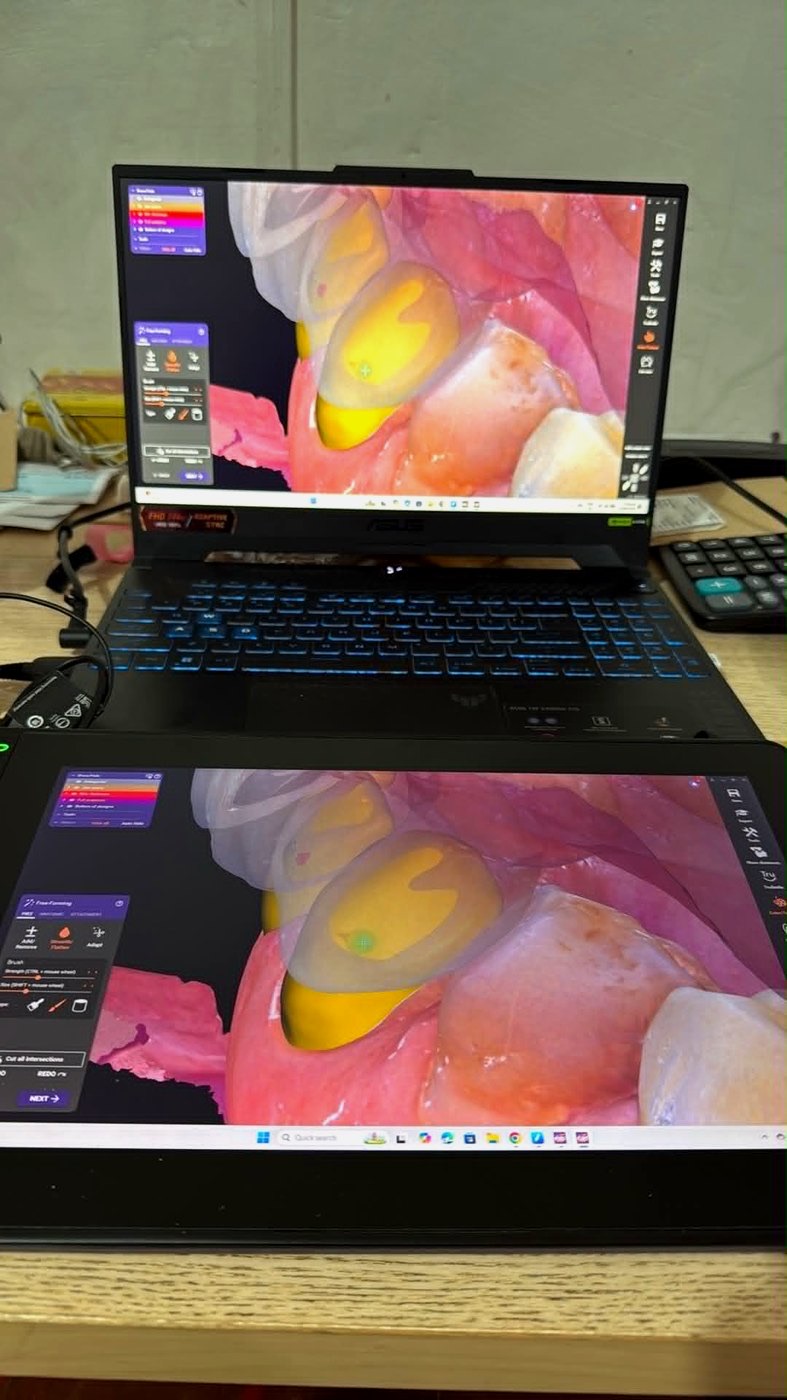 High-magnification view of a tooth on screen during treatment.